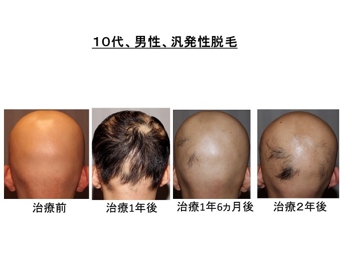 円形脱毛症　病院